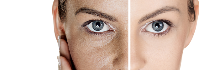 Plasma para rejuvenecer nuestra piel